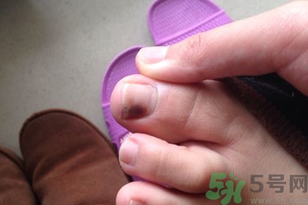 腳趾甲變黑是什么原因？腳趾甲變黑是怎么回事？