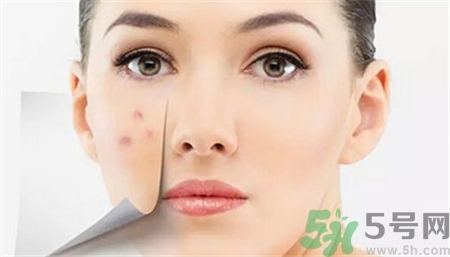 激光去痘印有效果嗎?激光祛痘會(huì)復(fù)發(fā)嗎? 激光去痘印有效果嗎?激光祛痘會(huì)復(fù)發(fā)嗎?