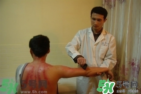 刮痧能治療風(fēng)寒感冒嗎？刮痧治療風(fēng)寒感冒效果好嗎