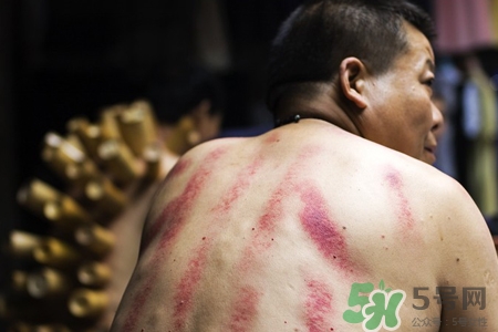 背部刮痧能減肥嗎？背部刮痧的有什么好處？