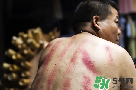 背部刮痧后能拔火罐嗎？背部刮痧后拔火罐有什么好處？