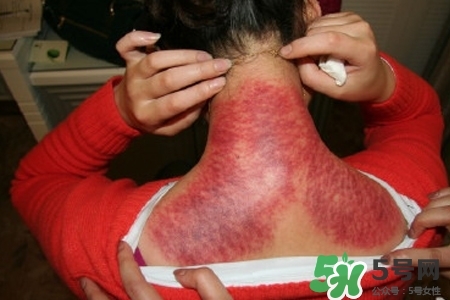 經常刮痧對身體好嗎？經常刮痧拔罐對身體有什么壞處嗎？