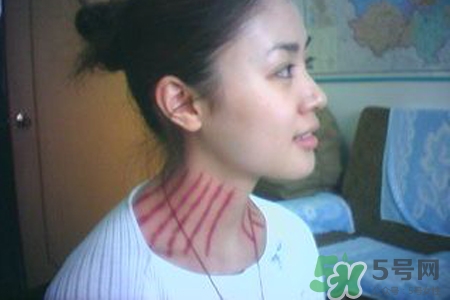 揪痧是什么？揪痧的好處有哪些？