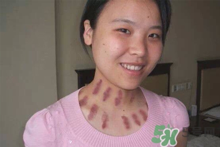 揪痧和刮痧哪個效果比較好？揪痧和刮痧的區(qū)別？