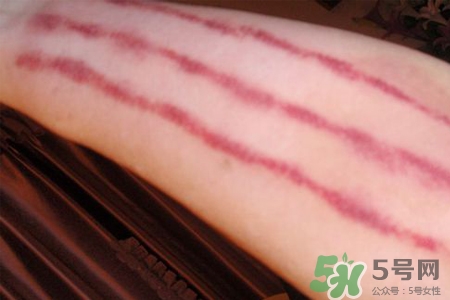 揪痧和刮痧哪個效果比較好？揪痧和刮痧的區(qū)別？