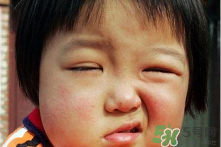 面癱能針灸嗎？針灸能治療面癱嗎？