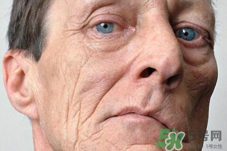 面癱能針灸嗎？針灸能治療面癱嗎？