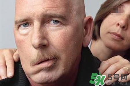 拔牙會(huì)導(dǎo)致面癱嗎?？拔牙為什么會(huì)導(dǎo)致面癱？