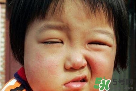 拔牙會導(dǎo)致面癱嗎?？拔牙為什么會導(dǎo)致面癱？