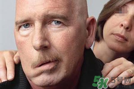 青少年面癱是怎么回事？青少年面癱是怎么辦？