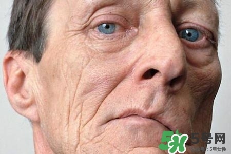 老年人為什么容易得面癱？老年人面癱原因有哪些？