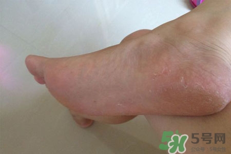 腳趾經常抽筋是缺鈣嗎？腳趾抽筋是什么原因？