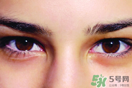 眼睛哭腫了怎么辦？眼睛哭腫了如何快速消腫？