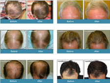 hairmax激光生發(fā)梳有用嗎?hairmax激光生發(fā)梳怎么樣? hairmax激光生發(fā)梳有用嗎?hairmax激光生發(fā)梳怎么樣?