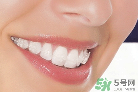 隱形牙套矯正多少錢？隱形牙套多少錢一副？