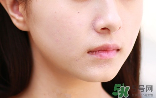 黑色痘印怎么消除小妙招?黑色痘印會自己消失嗎 黑色痘印怎么消除小妙招?黑色痘印會自己消失嗎