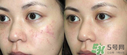 黑色痘印怎么消除小妙招?黑色痘印會自己消失嗎 黑色痘印怎么消除小妙招?黑色痘印會自己消失嗎