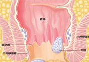 怎樣辨別外痔和內(nèi)痔？外痔和內(nèi)痔的區(qū)別