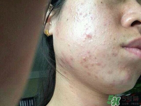 閉合性粉刺怎么消除?閉合性粉刺怎么根除? 閉合性粉刺怎么消除?閉合性粉刺怎么根除?