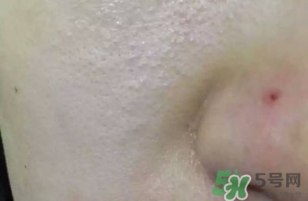 閉合性粉刺怎么消除?閉合性粉刺怎么根除? 閉合性粉刺怎么消除?閉合性粉刺怎么根除?