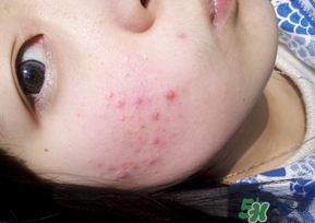 閉合性粉刺能自愈嗎?閉合性粉刺可以自愈嗎? 閉合性粉刺能自愈嗎?閉合性粉刺可以自愈嗎?