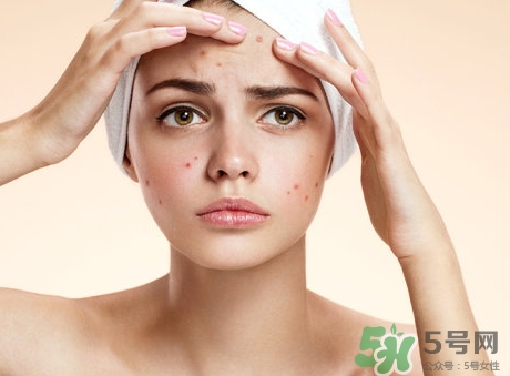 閉合性粉刺能自愈嗎?閉合性粉刺可以自愈嗎? 閉合性粉刺能自愈嗎?閉合性粉刺可以自愈嗎?