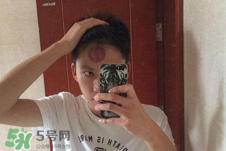 拔罐后皮膚癢能撓嗎？拔罐后身上癢切忌抓撓