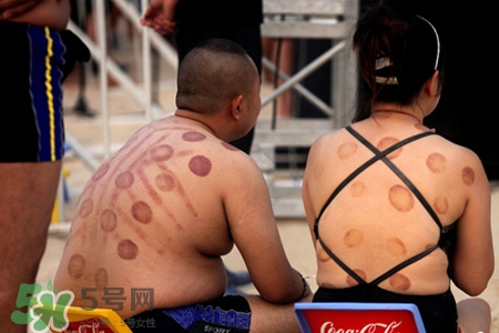 拔罐后可以喝酒嗎？拔罐后多久能喝酒？