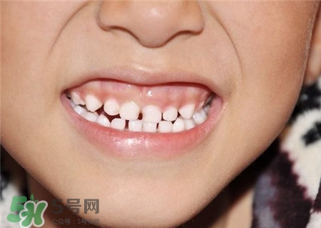 孩子換牙乳牙不掉怎么辦?換牙可以拔掉嗎? 孩子換牙乳牙不掉怎么辦?換牙可以拔掉嗎?