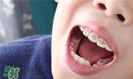 孩子換牙乳牙不掉怎么辦?換牙可以拔掉嗎? 孩子換牙乳牙不掉怎么辦?換牙可以拔掉嗎?