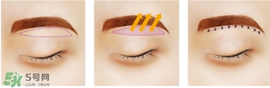 切眉后眼睛腫怎么辦？切眉后眼睛變形怎么回事怎么辦？