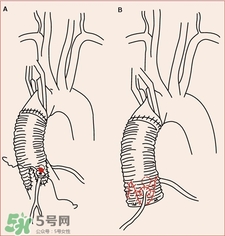 人造血管可以用多久?人造血管的護(hù)理 人造血管可以用多久?人造血管的護(hù)理