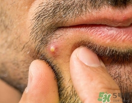 針清痘痘真的能好嗎?針清痘痘后幾天能好? 針清痘痘真的能好嗎?針清痘痘后幾天能好?