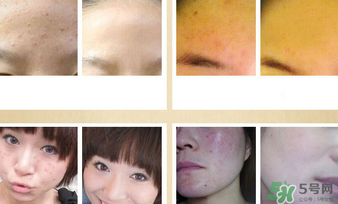 伊詩蘭頓祛痘怎么樣？伊詩蘭頓祛痘膏有用嗎？