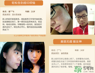芷軒堂祛痘有效果嗎？芷軒堂祛痘印效果怎么樣？