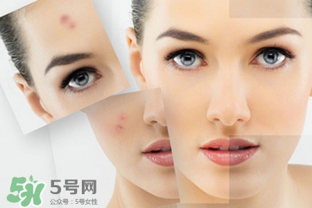 祛痘產(chǎn)品排行榜10強(qiáng) 2017祛痘小妙招 祛痘產(chǎn)品排行榜10強(qiáng) 2017祛痘小妙招