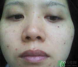 激光點痣會留疤嗎?激光點痣會留坑嗎? 激光點痣會留疤嗎?激光點痣會留坑嗎?