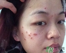 激光點痣會留疤嗎?激光點痣會留坑嗎? 激光點痣會留疤嗎?激光點痣會留坑嗎?