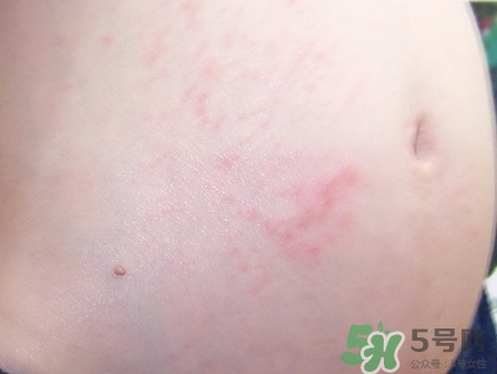 懷孕6個月肚子上長紅點點是怎么回事? 懷孕6個月肚子上長紅點點是怎么回事?