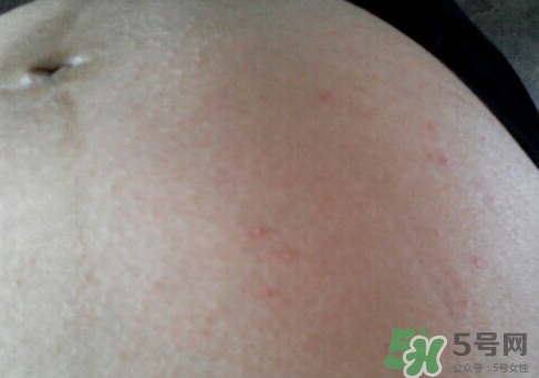 懷孕6個月肚子上長紅點點是怎么回事? 懷孕6個月肚子上長紅點點是怎么回事?