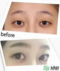 埋線雙眼皮多久恢復(fù)自然？埋線雙眼皮多久能恢復(fù)