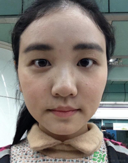 埋線雙眼皮的危害_埋線雙眼皮有風險后遺癥嗎 埋線雙眼皮的危害_埋線雙眼皮有風險后遺癥嗎