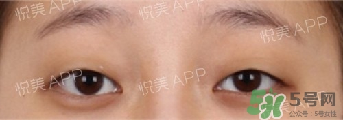 埋線雙眼皮多久恢復(fù)自然？埋線雙眼皮多久能恢復(fù)