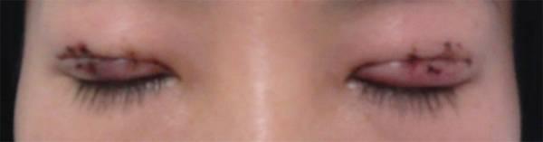 三點雙眼皮恢復(fù)過程圖_韓式三點雙眼皮多久恢復(fù)自然