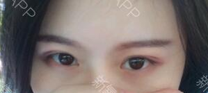 定點雙眼皮能保持多久？定點雙眼皮是永久的嗎？