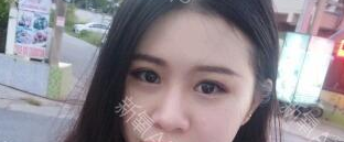 定點雙眼皮能保持多久？定點雙眼皮是永久的嗎？