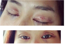 定點雙眼皮怎么做？定點雙眼皮需要拆線嗎？