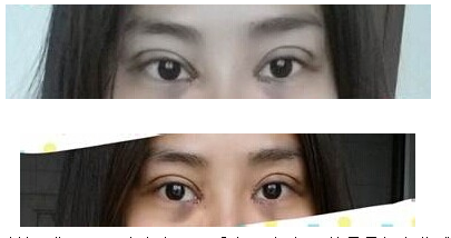 定點雙眼皮怎么做？定點雙眼皮需要拆線嗎？