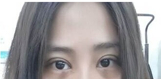 定點雙眼皮怎么做？定點雙眼皮需要拆線嗎？