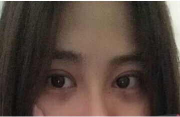 定點雙眼皮怎么做？定點雙眼皮需要拆線嗎？